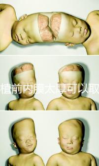 移植前內膜太厚可以取卵早知道，疼痛因人而異