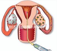 別還不造內膜10mm鮮胚容不容易著床,能否移植看這幾點