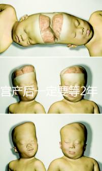 剖宮產后一定要等2年，才能試管嬰兒懷孕嗎？