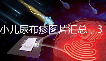 小兒尿布疹圖片匯總，3種類型癥狀大不一樣