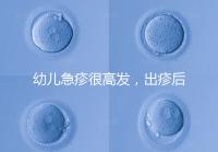 幼兒急疹很高發(fā)，出疹后的護(hù)理方法及注意事項(xiàng)提前知曉！