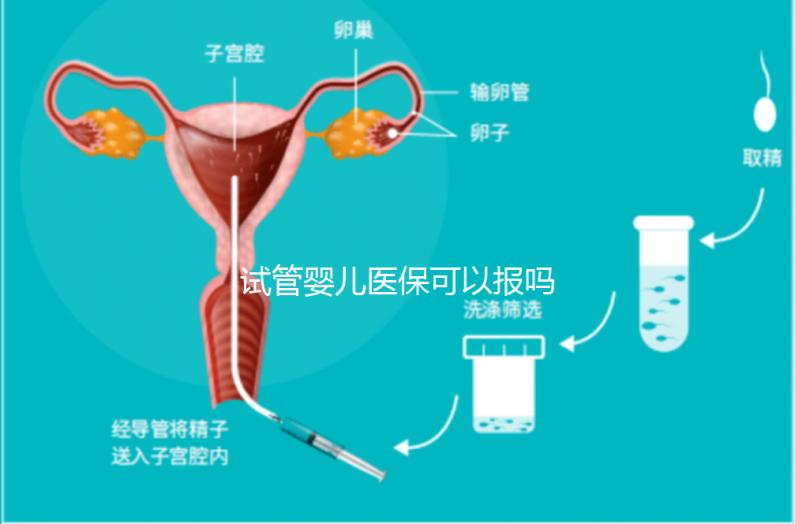 試管嬰兒醫(yī)?？梢詧?bào)嗎